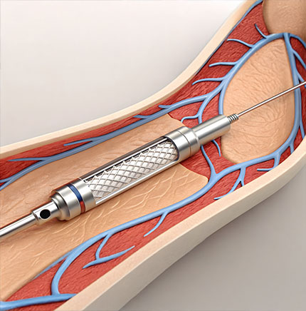 Worst-Case Assessments to Best-Case Solutions: Optimizing Biocompatibility Testing for Medical Devices